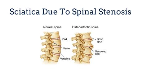 Sciatica Due To Spinal Stenosis Gray Chiropractic Stcatharines Spine