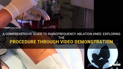 A Comprehensive Guide To Radiofrequency Ablation Knee Exploring The