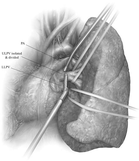 Technique Of Video Assisted Thoracoscopic Left Pneumonectomy