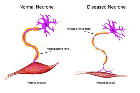 what is motor neurone disease lima s blog