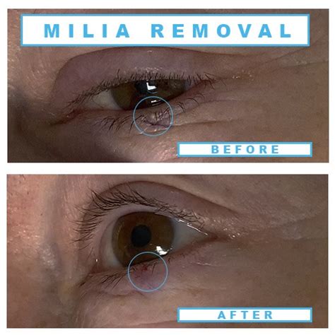 Milia Removal Treatments In Birmingham Milia Eyelid And Eyelash Milia