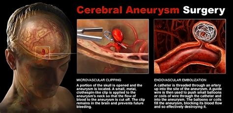 How Are Cerebral Aneurysms Treated Storymd