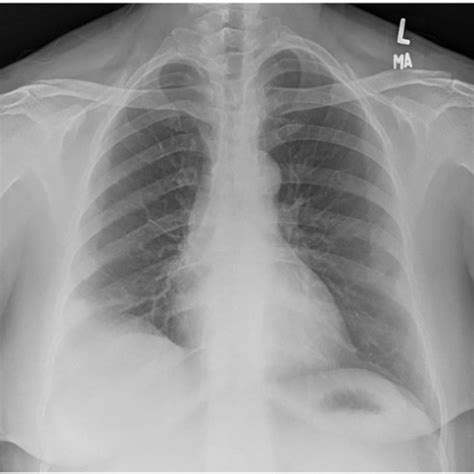 Chest X Ray Preoperatively With Blunting At The Right Costophrenic