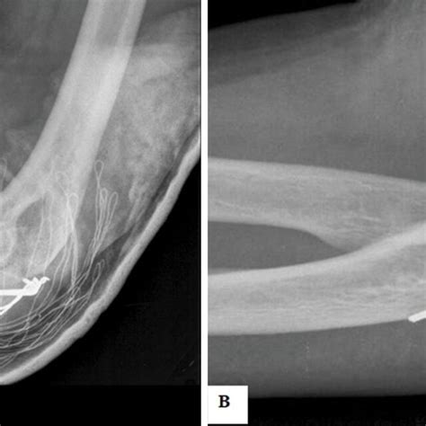 Roentgenograms Of The Olecranon Fracture In An Above Elbow Cast A
