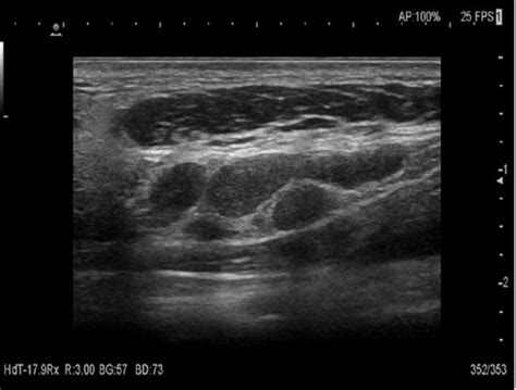 Cervical Lymphadenopathy Ultrasound