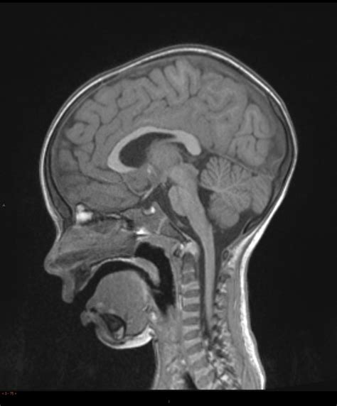 Normal Mri Head 3 Years Old Image