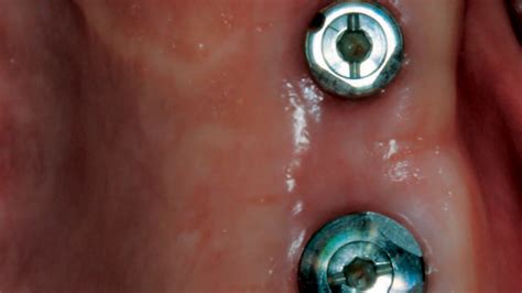 Implant Placement With Augmentation And Osteotomy Sinus Elevation Decisions In Dentistry