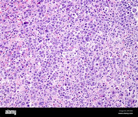 Diffuse Large B Cell Lymphoma Light Micrograph Stock Photo Alamy