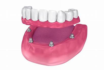 Implants Dental Restore Smile Whole
