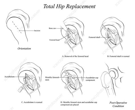 Total Hip Replacement Illustration Stock Image C039 3490 Science Photo Library