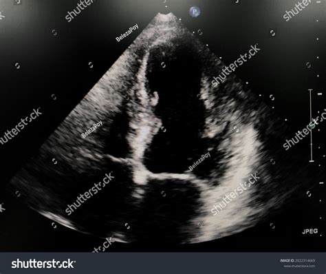 Transthoracic Echocardiogram Tte Modified Apical Chamber Stock Photo Shutterstock