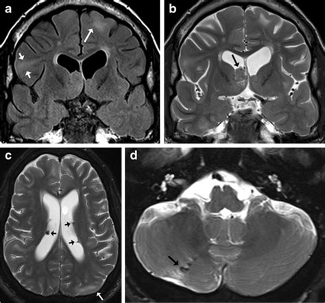 Imaging Findings Of Tuberous Sclerosis Complex A Coronal T2 Flair And