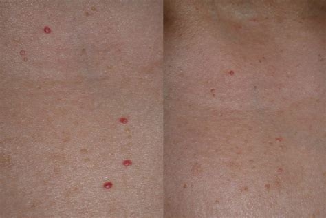 Cherry Angioma Removal In Mississauga Allura Skin And Laser Centre