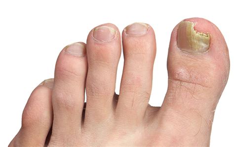 Fungal Nail Infection Onychomycosis