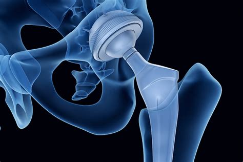 Everything You Need To Know About Direct Anterior Hip Replacements