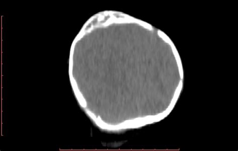 Calcified Cephalohematoma Image