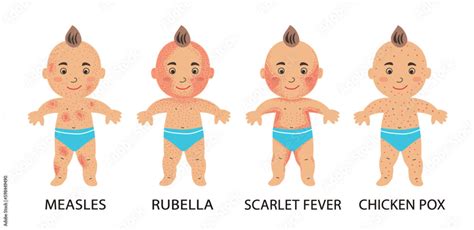 Infographics Of Childhood Rash Measles Rubella Scarlet Fever