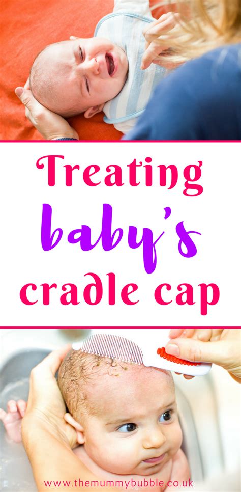 How To Get Rid Of Babys Cradle Cap For Good Baby Cradle Cap Cradle