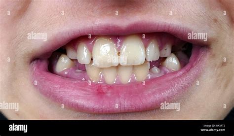Oral And Dental Health Tartar And Black Spots On The Teeth Stock Photo