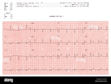 Electrocardiograma Mostrando El Ritmo Sinusal Normal Fotografía De