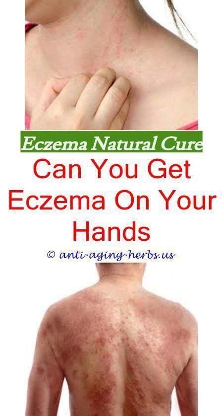 Howtotreatcellulite Eczema Lotion Eczema Cure Eczema Remedies
