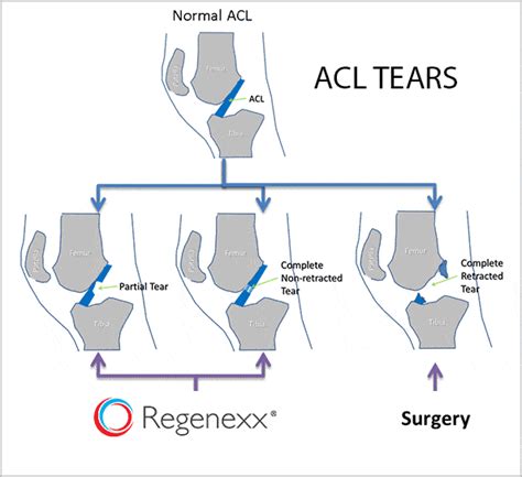 Regenexx Acl Repair For Torn Anterior Cruciate Ligament Andrew M