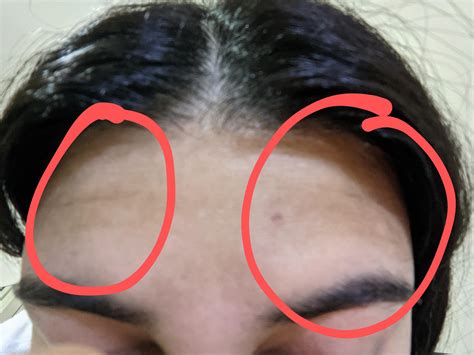 Skin Concerns 22f With 4 Deep Lines Across Forehead Tried