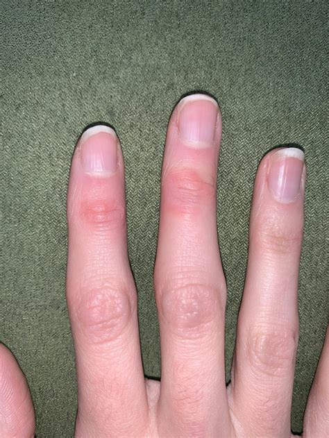 Finger Bumps Anyone Have These They Sometimes Hurt And Come And Go