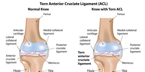 In this article, we will go deep into the functionality of acls, and. Grades of ACL Tear: Causes, Symptoms and Treatment ...