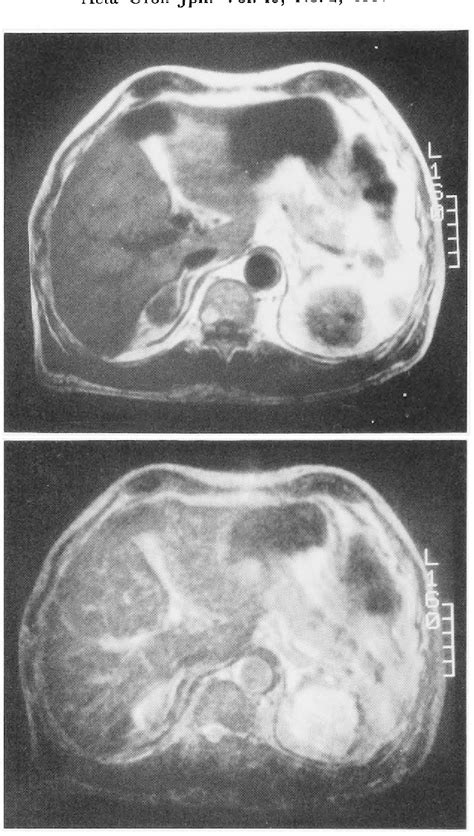 Figure 2 From A Case Of Exophytic Hepatic Hemangioma Mimicking Adrenal
