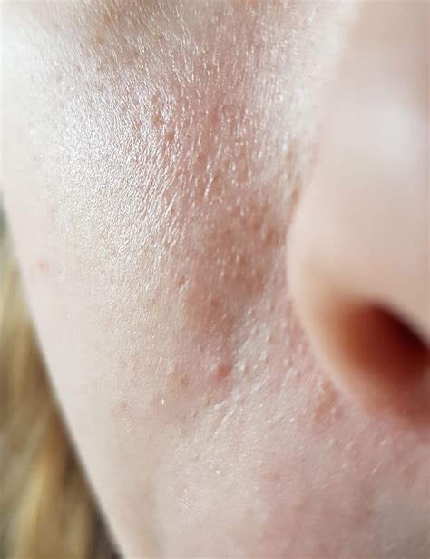 Skin Concerns People With Clogged Pores Bumpy Skin How Were You Able To Get Rid Of Them R