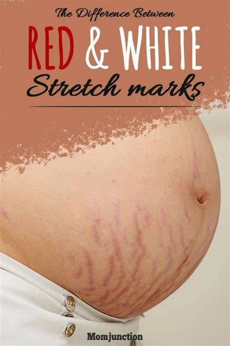The Difference Between Red And White Stretch Marks Usually These