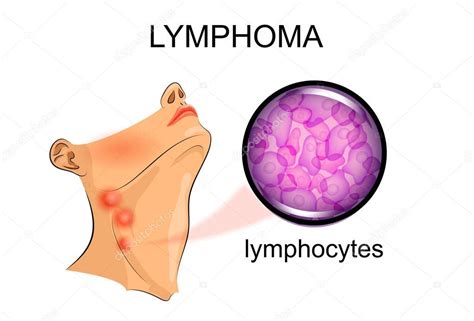 ganglios linfáticos inflamados en el linfoma Oncología