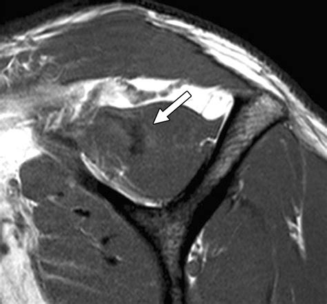 Supraspinatus Myotendinous Junction Injuries Mri Findings And