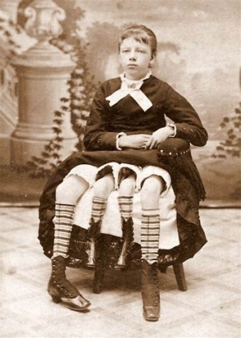 Myrtle Corbin Was A Four Legged Woman Who Had Five Kids Of Her Own