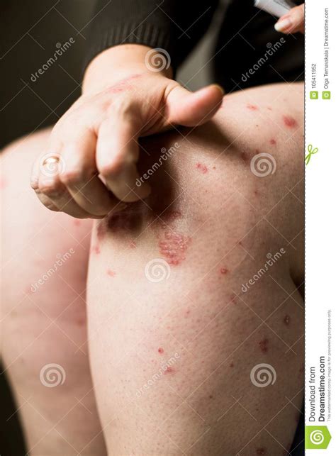 The Problem With Many People Eczema Or Psoriasis On Hand Skin Woman