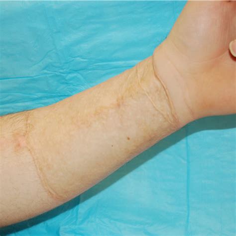 Outline Of The Radial Forearm Free Flap Phalloplasty On The Arm The