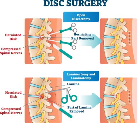 Sciatica Surgery Types Laser Spine Center