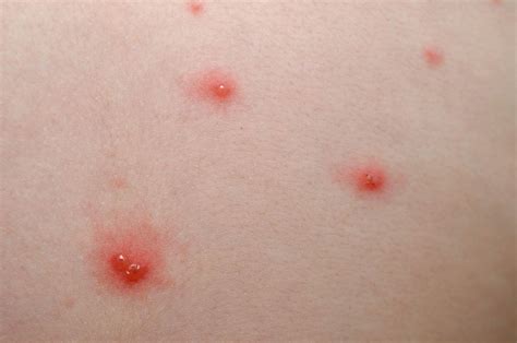 Herpes Pictures And Cold Sores Pictures