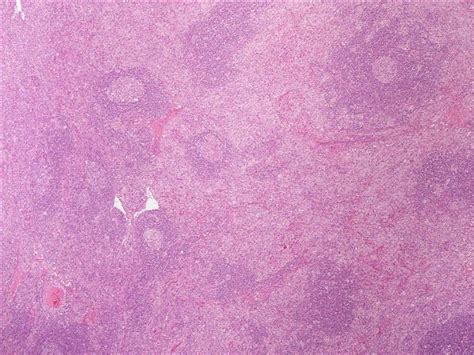 Pathology Outlines Mixed Cellularity Classic Hodgkin Lymphoma