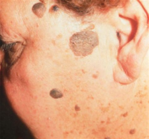 Seborrheic Keratosis Is A Medical Term Used To Define A Benign