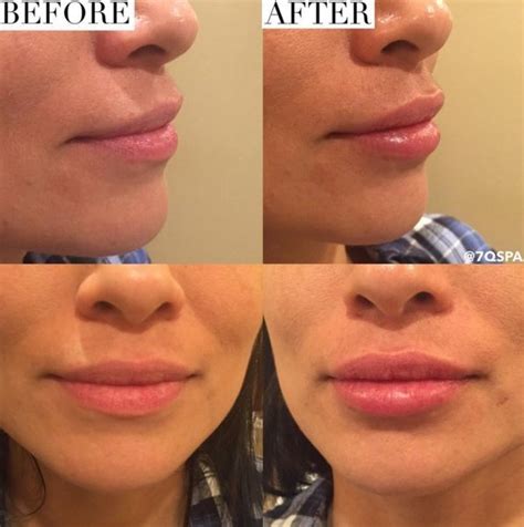 Before After Lip Fillers Using Juvederm Ultra Plus Xc Syringe Was