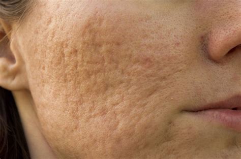 Rosacea And Enlarged Pores Livestrongcom