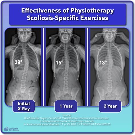 Scoliosis Treatment For Children And Teens Scoliosis Care Centers