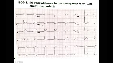 1 Inferior Wall Mi Heart Attack Ecg Ekg Electrocardiogram Uri Ben Zur