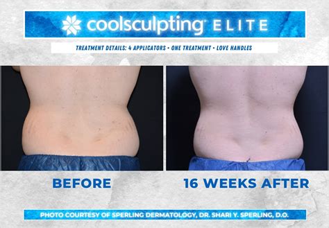 Love Handles CoolSculpting Before After Patient 45 Sperling Dermatology