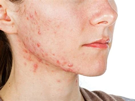 6 Main Types Of Acne And How To Recognize Them Talk About Skincare