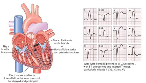 Left Bundle Branch Block Cardiac Nursing Paramedic Acls