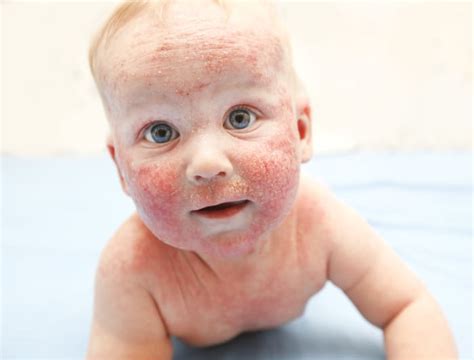 Is It A Rash Or Baby Acne Wehavekids