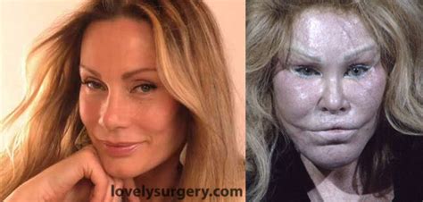 Jocelyn Wildenstein Before And After Plastic Surgery Lovely Surgery Celebrity Before And